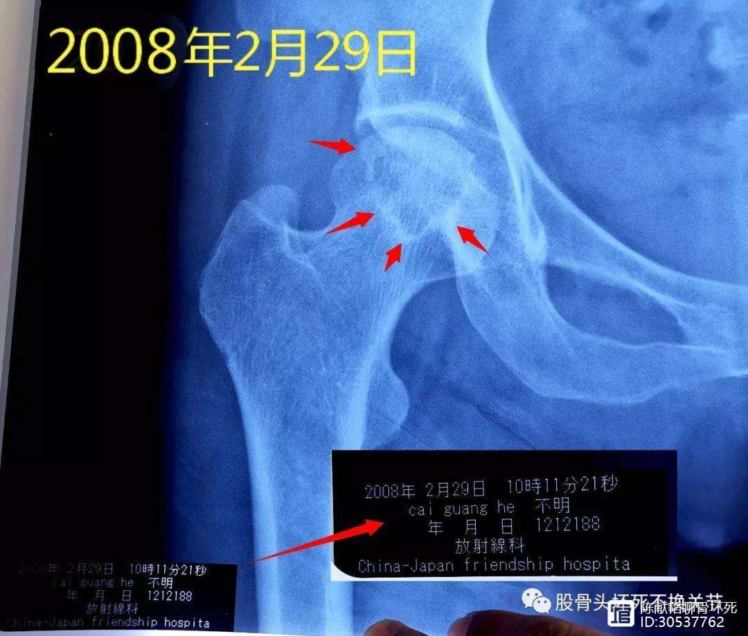 广州人工骨头医保报销多少(人工骨头医保报销多少比例)